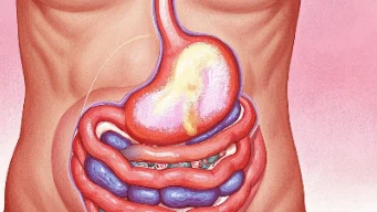 胃癌晚期：我们还能为自己健康做些什么？