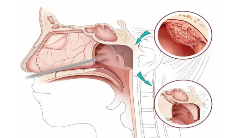 远离鼻咽癌——了解与预防指南