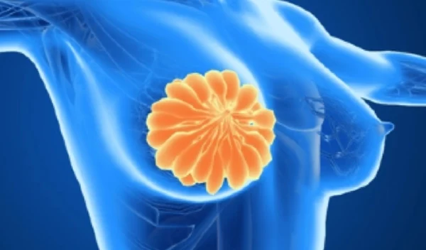 乳房肿物:常见但必须警惕的健康隐患!