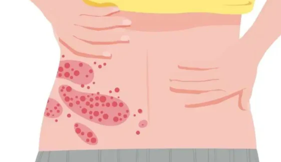 警惕带状疱疹——不仅仅是皮肤问题!