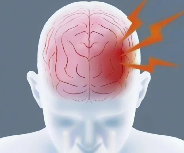 脑梗塞的发展与管理：科学应对，健康生活