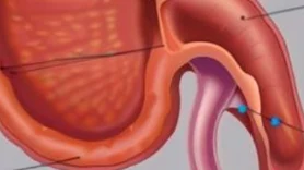 探索阑尾肿瘤：诊断、治疗与管理