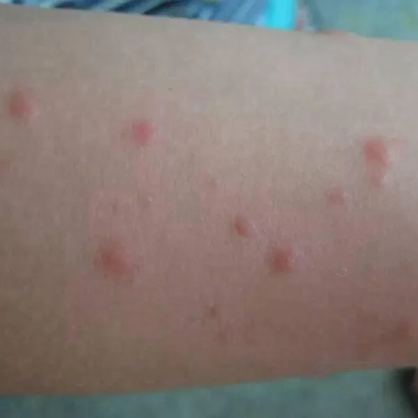 过敏性皮疹：从诊断到管理的全面指南