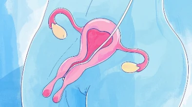 阴道癌:早发现、早治疗,女性健康的守护者