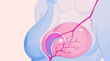 乳腺癌早期症状与治疗方法解析