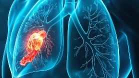 肺癌的心胸外科视角:了解、识别和应对