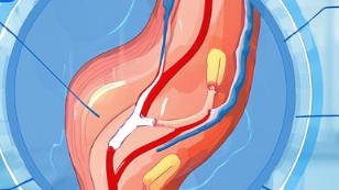 揭秘混合痔：<span style="color: #da4707">常见疾病</span>未曾知的秘密