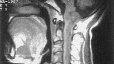 脑神经疾病知多少？——从神经鞘瘤到药物治疗的全面解析