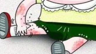 皮肤问题大作战:由过敏性皮炎到睡眠障碍