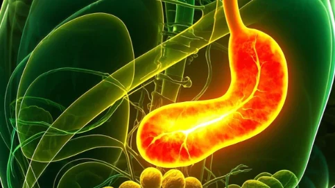 胆总管结石伴胆管炎:深入解析及管理指南