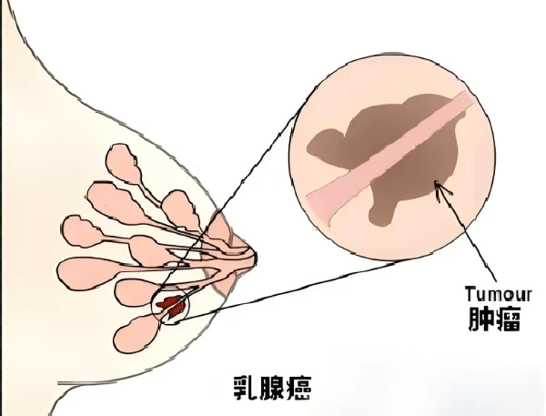 了解乳腺癌:早期发现,科学治疗,生命之光!