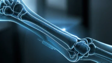 肱骨干骨折手术麻醉管理指南：保驾护航你的健康之旅