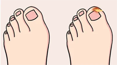 了解你的指甲健康：别让甲沟炎找上门