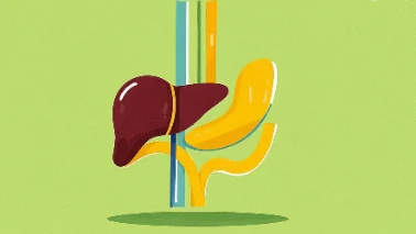 消除胆囊结石困扰：全面识别与治疗指南